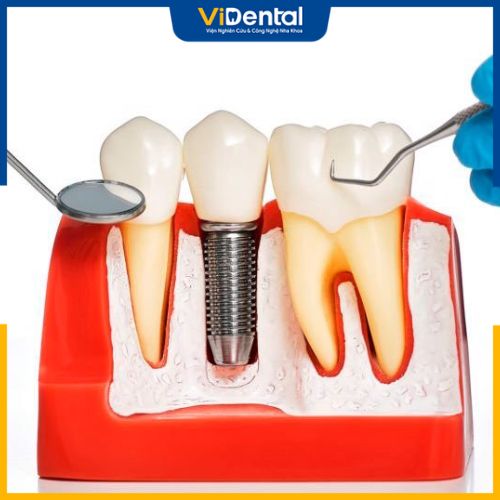 Trồng răng Implant là phương pháp hiệu quả nhưng chi phí khá cao