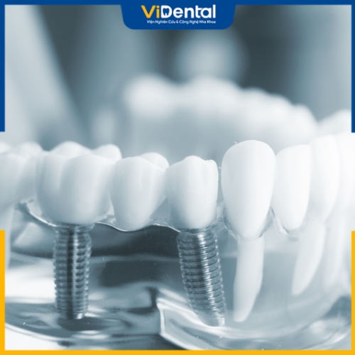 Nhiều người tìm kiếm dịch vụ trồng răng Implant giá rẻ tại TPHCM