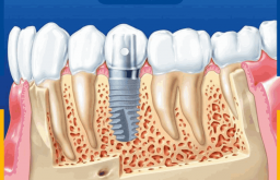 11 Địa Chỉ Trồng Răng Implant Giá Rẻ Tại TPHCM Uy Tín Nhất
