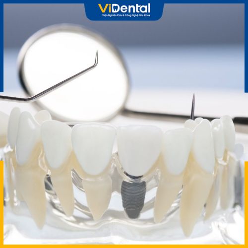 Trồng răng trả góp Implant được nhiều khách hàng lựa chọn
