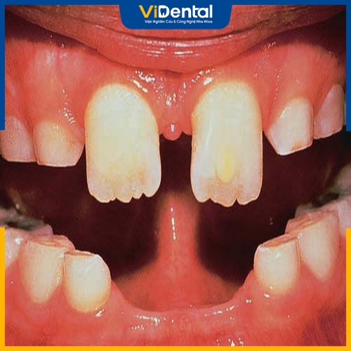 Thiếu răng bẩm sinh là hiện tượng răng mọc thiếu so với thông thường