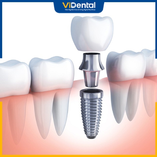 Phương pháp trồng răng Implant được nhiều người lựa chọn