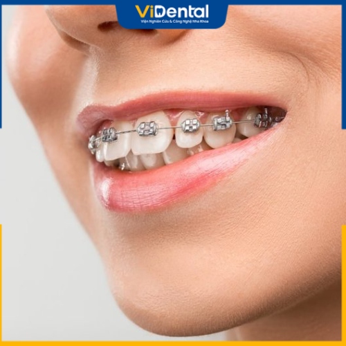 Phương pháp niềng răng sẽ khắc phục được khoảng trống hàm