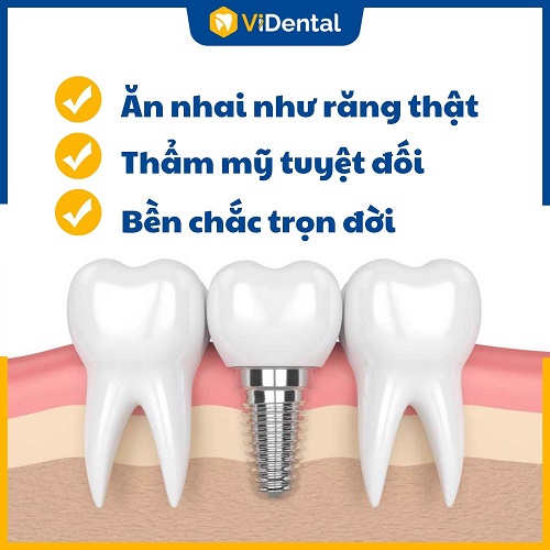 ViDental Implant cam kết quá trình trồng răng không đau, hiệu quả