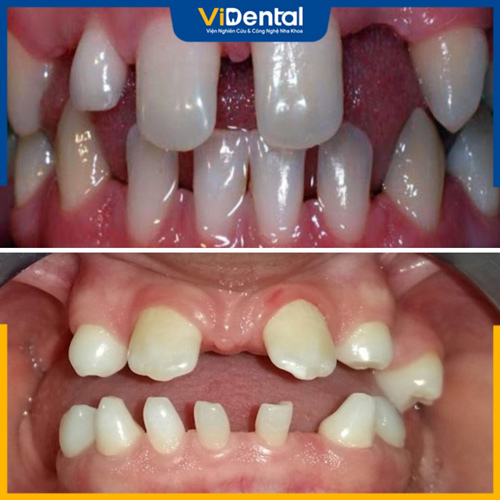 Nhiều nguyên nhân có thể dẫn đến việc thiếu một hoặc nhiều răng bẩm sinh