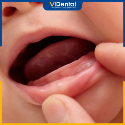 Tình trạng răng sữa mọc thiếu thường không có triệu chứng