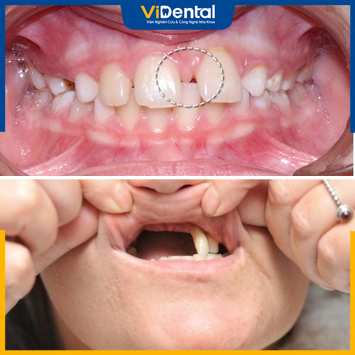 Tình trạng thiếu khuyết răng bẩm sinh gây ra suy giảm chức năng ăn nhai