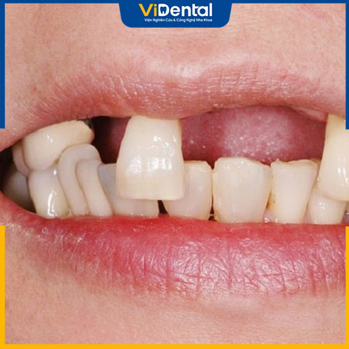 Mất nhiều răng gây ra nhiều ảnh hưởng đối với sức khỏe, cuộc sống