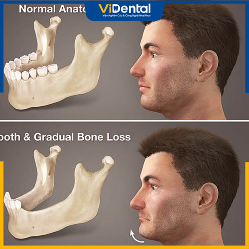 Nếu mất răng nhưng không xử lý sớm có thể gây tiêu xương hàm