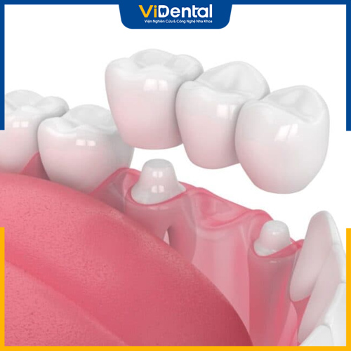 Làm cầu răng sứ thích hợp với những người mất nhiều răng liền kề nhau