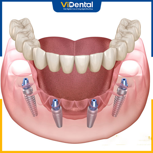 Cấy ghép Implant là phương pháp trồng răng hiện đại nhất