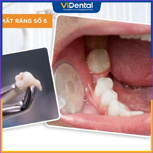 Mất răng hàm gây ra nhiều tác hại đối với cơ thể