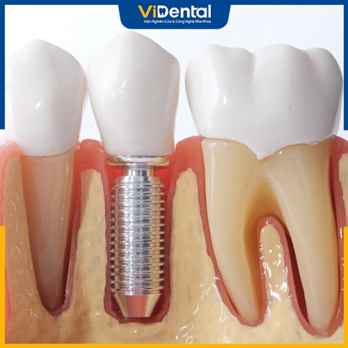 Cấy ghép Implant là biện pháp khắc phục mất răng hàm hiện đại nhất hiện nay